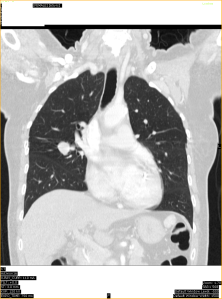 Carcinoid lung tumour 1C